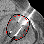 Cryoablation planning