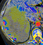 Hemangioma perfusion