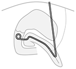 Transgastric pancreatic duct drain