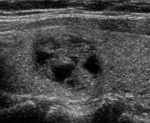 thyroid nodule