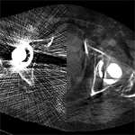 CT artifact reduction