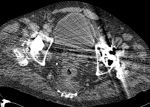 bilateral hip replacement metal artifact (FBP)