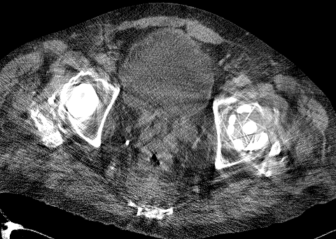 bilateral hip replacement metal artifact reduction (MDT)