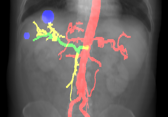 virtual angiogram
