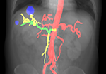 Virtual angiography